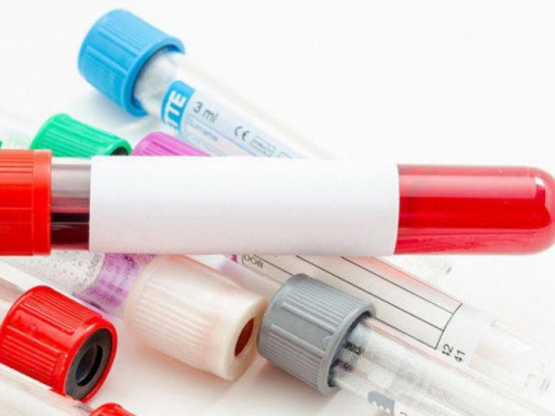 ВИЧ и СПИД: как в Авдеевке пройти анонимное бесплатное тестирование