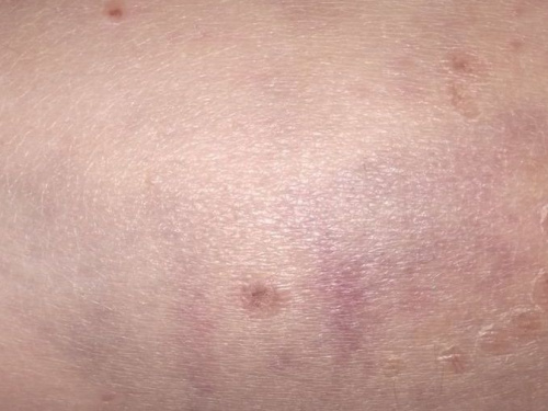 В Авдеевке собаки опять покусали ребенка