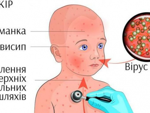 В Украине повысился риск вспышки кори