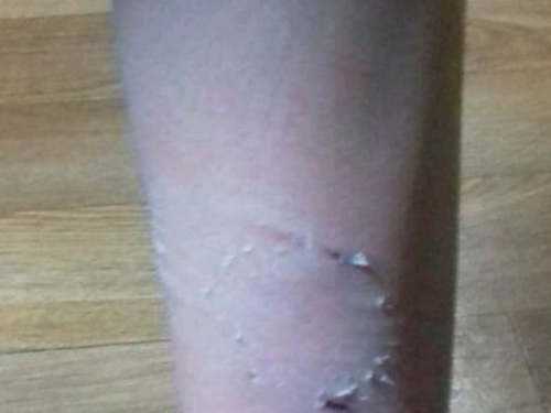 В Авдеевке очередной случай нападения собаки на человека (ФОТОФАКТ)